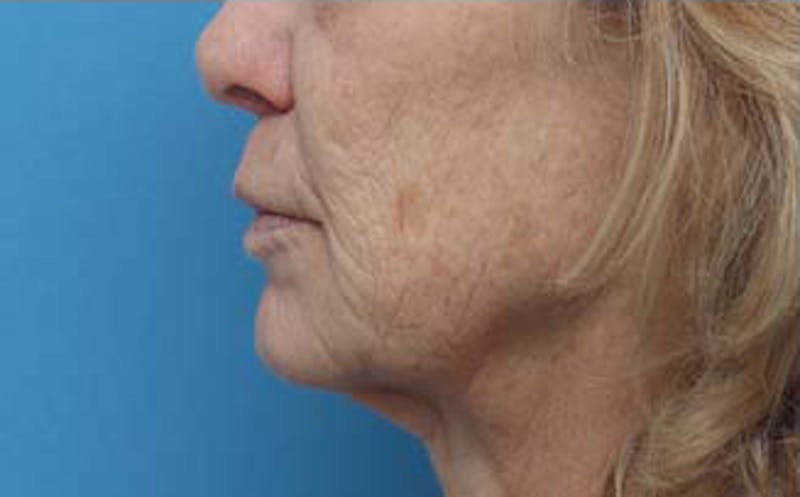 Dermabrasion Before & After Gallery - Patient 384622 - Image 7