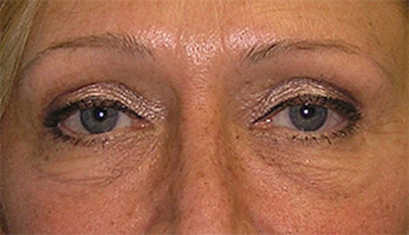 Eyelid Surgery Before & After Gallery - Patient 407452 - Image 1