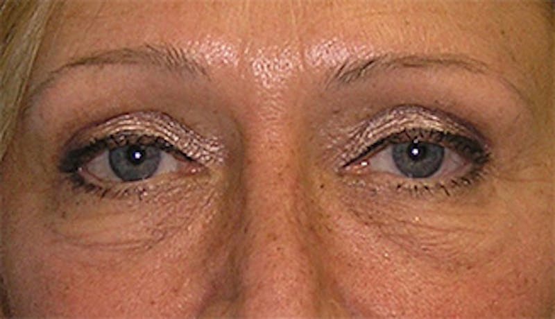 Patient D7Ap0fuYQUW3Li28Cmg64A - Eyelid Surgery Before & After Photos