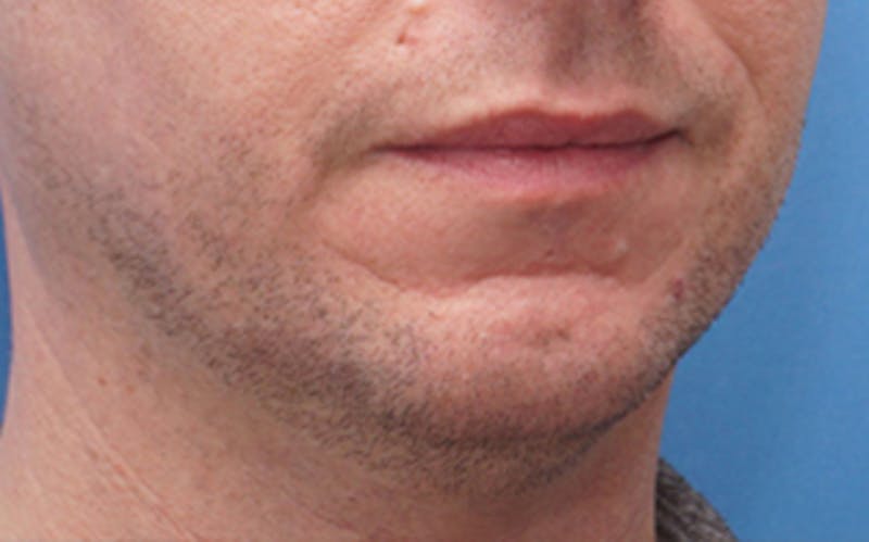 Chin Surgery Before & After Gallery - Patient 425140 - Image 7