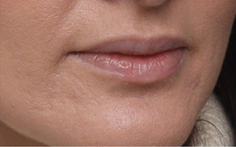 Lip Fillers Before & After Gallery - Patient 160802 - Image 5