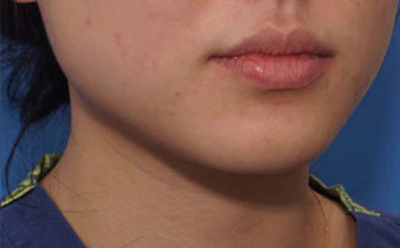 BOTOX Before & After Gallery - Patient 311603 - Image 1