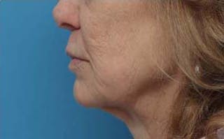 Dermabrasion Before & After Gallery - Patient 384622 - Image 8