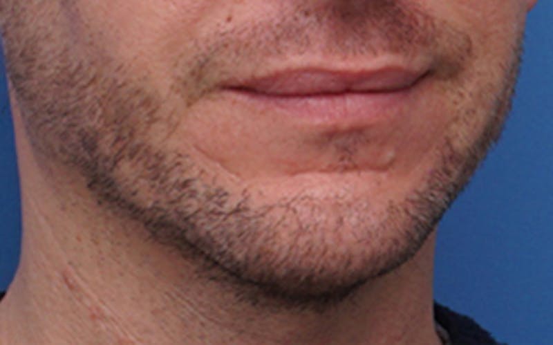 Chin Surgery Before & After Gallery - Patient 425140 - Image 8