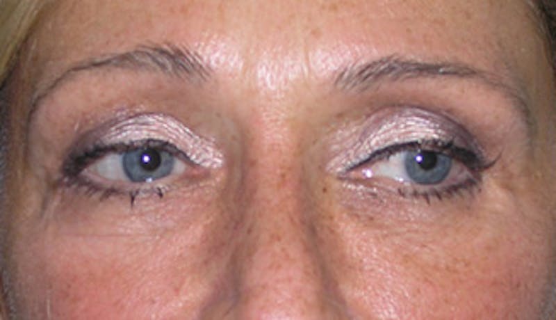 Eyelid Surgery Before & After Gallery - Patient 407452 - Image 2