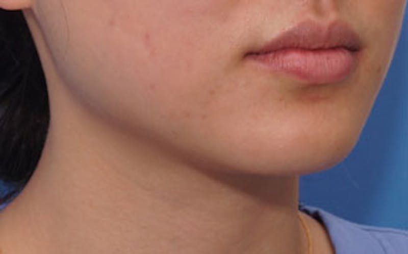 BOTOX Before & After Gallery - Patient 311603 - Image 2