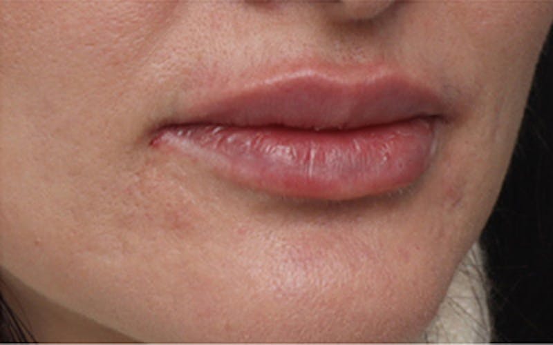 Lip Fillers Before & After Gallery - Patient 160802 - Image 6