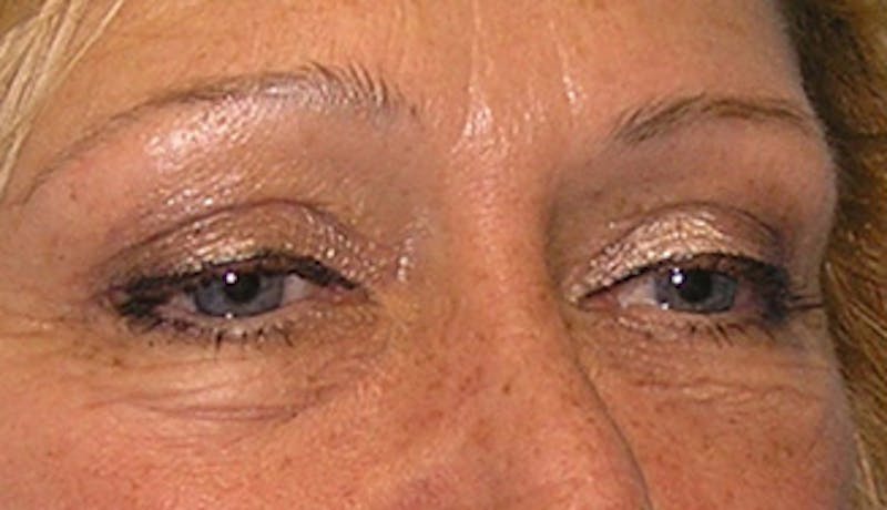 Eyelid Surgery Before & After Gallery - Patient 407452 - Image 3