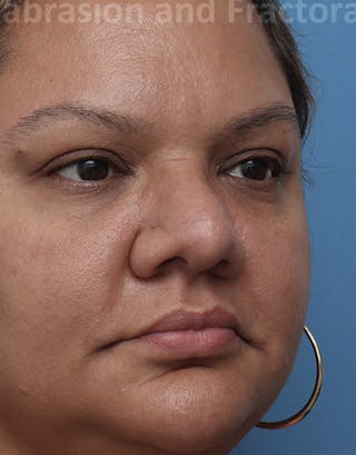 Fractora / Morpheus Before & After Gallery - Patient 154483 - Image 4