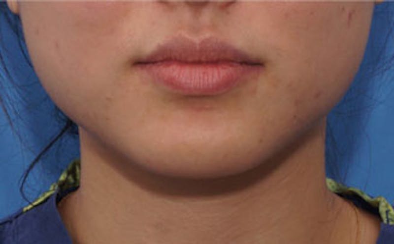 BOTOX Before & After Gallery - Patient 311603 - Image 3