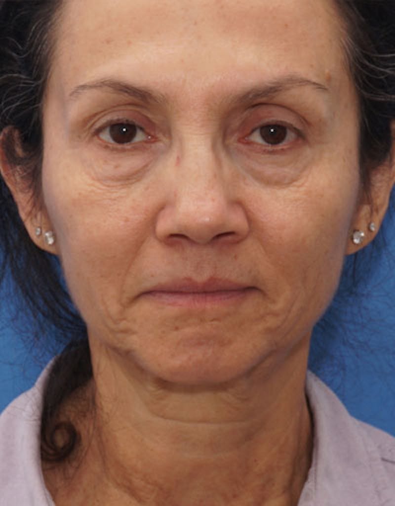 FaceTite Before & After Gallery - Patient 136492 - Image 1