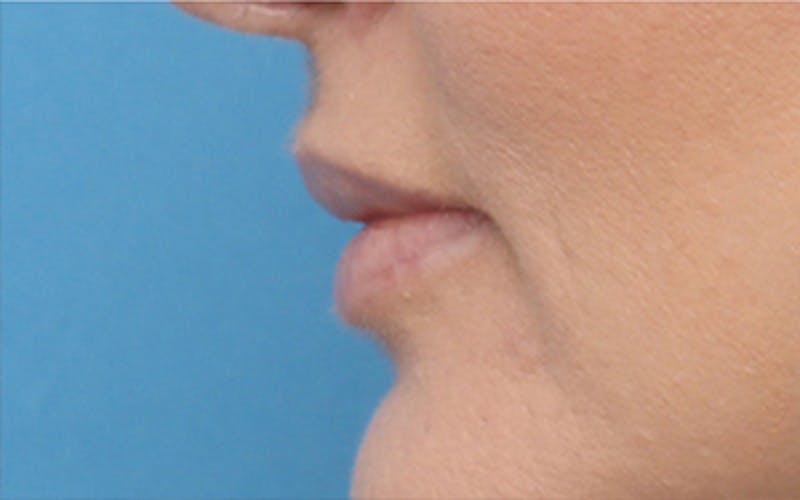 Lip Fillers Before & After Gallery - Patient 160802 - Image 7