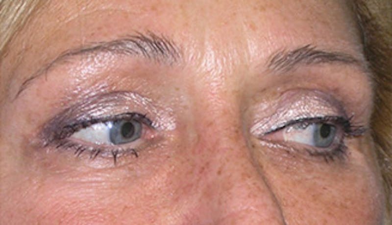 Eyelid Surgery Before & After Gallery - Patient 407452 - Image 4