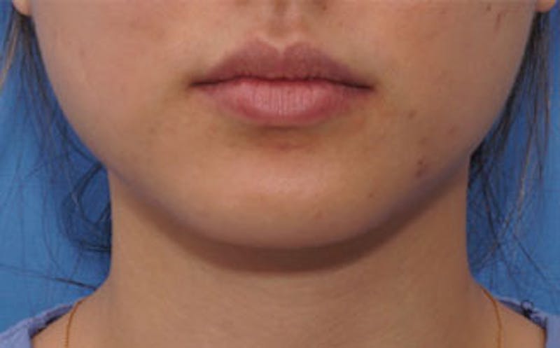BOTOX Before & After Gallery - Patient 311603 - Image 4