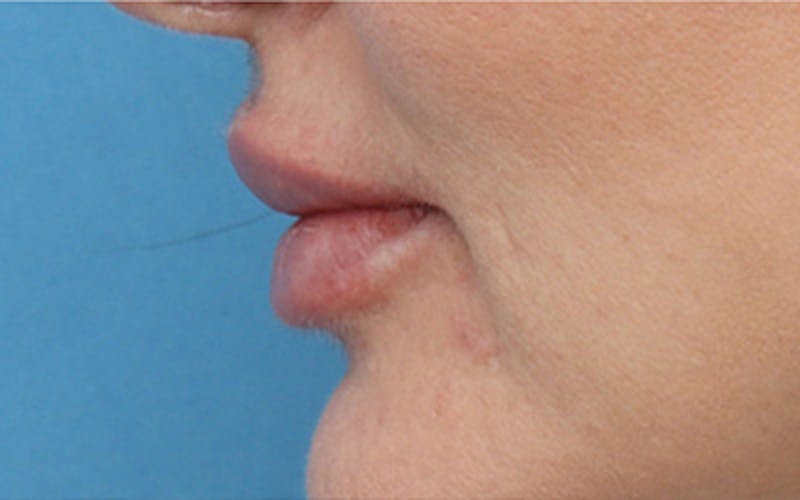 Lip Fillers Before & After Gallery - Patient 160802 - Image 8