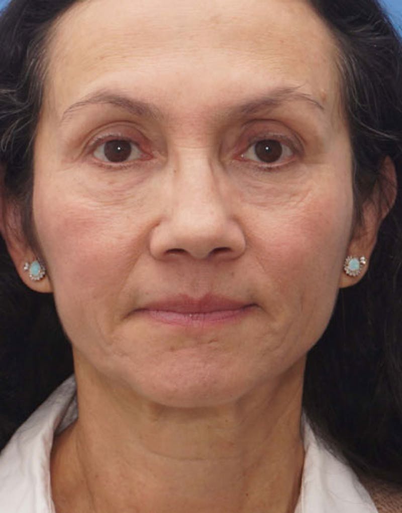 FaceTite Before & After Gallery - Patient 136492 - Image 4