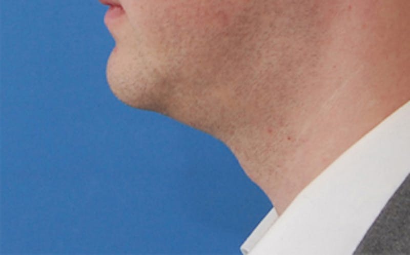 Kybella Before & After Gallery - Patient 127683 - Image 7