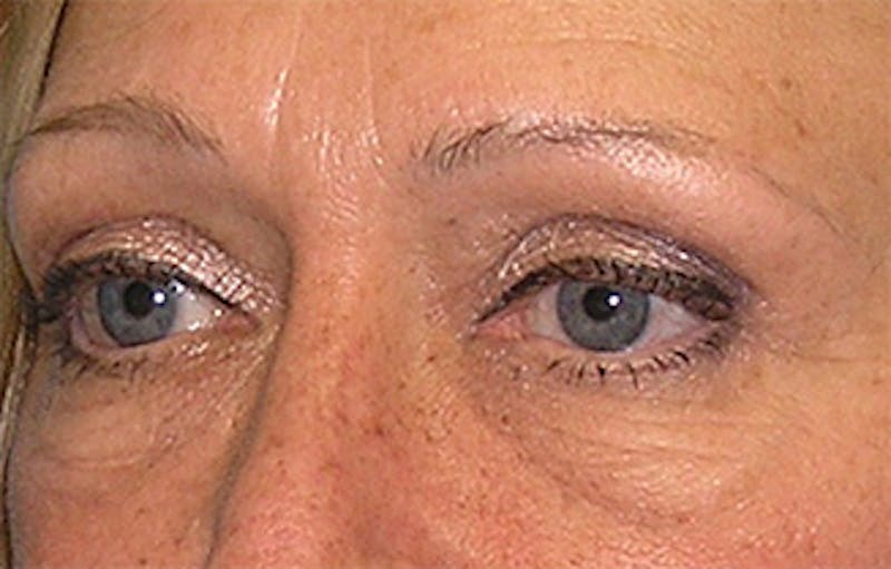 Eyelid Surgery Before & After Gallery - Patient 407452 - Image 5