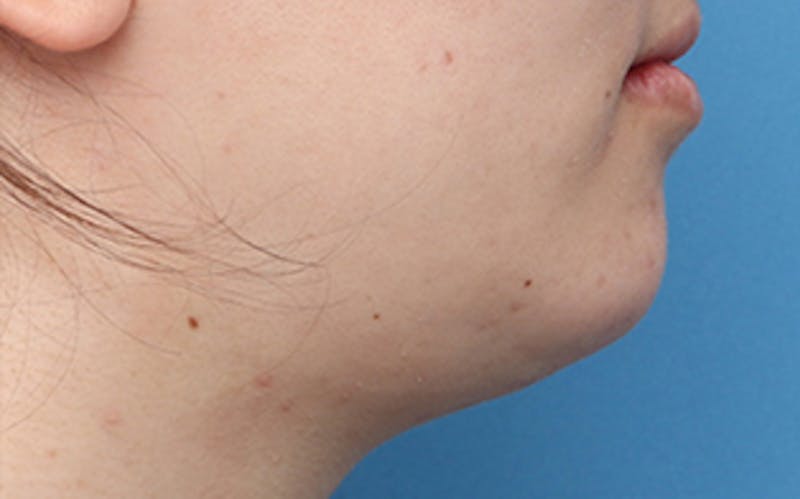 Chin Surgery Before & After Gallery - Patient 317660 - Image 2