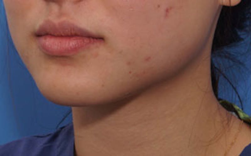 BOTOX Before & After Gallery - Patient 311603 - Image 5