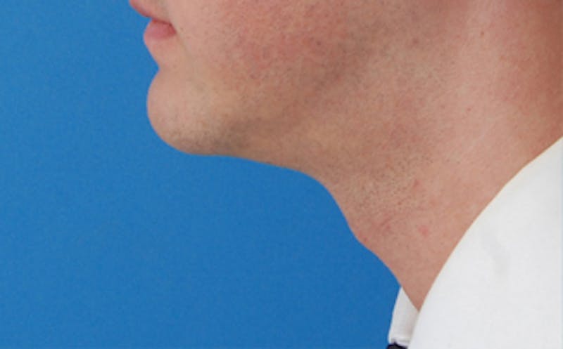 Kybella Before & After Gallery - Patient 127683 - Image 8