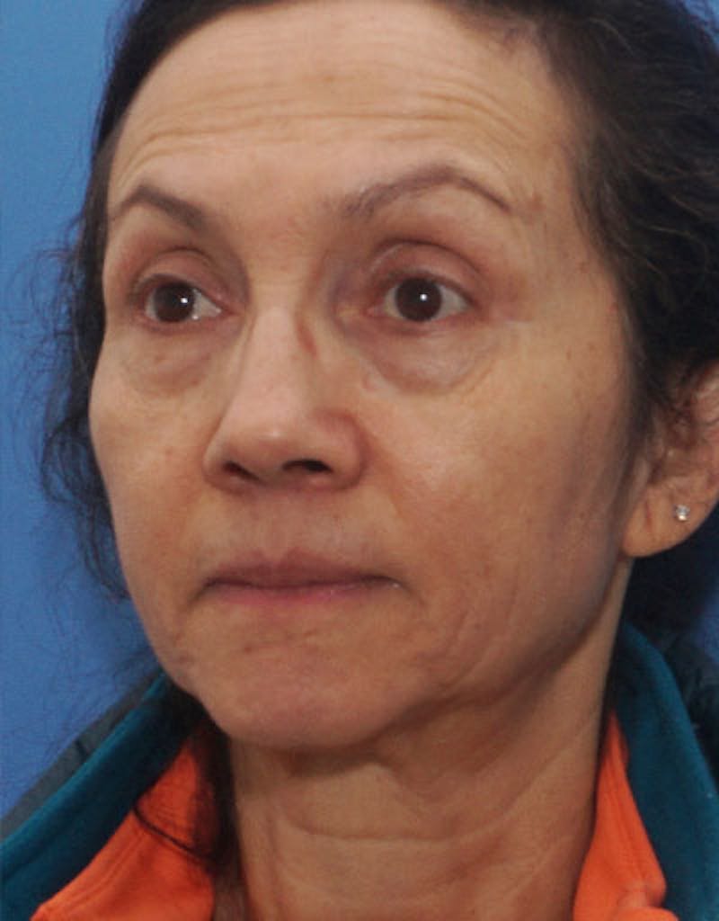 Patient FwD3JP0BS9WmubnzgNQzGQ - FaceTite Before & After Photos