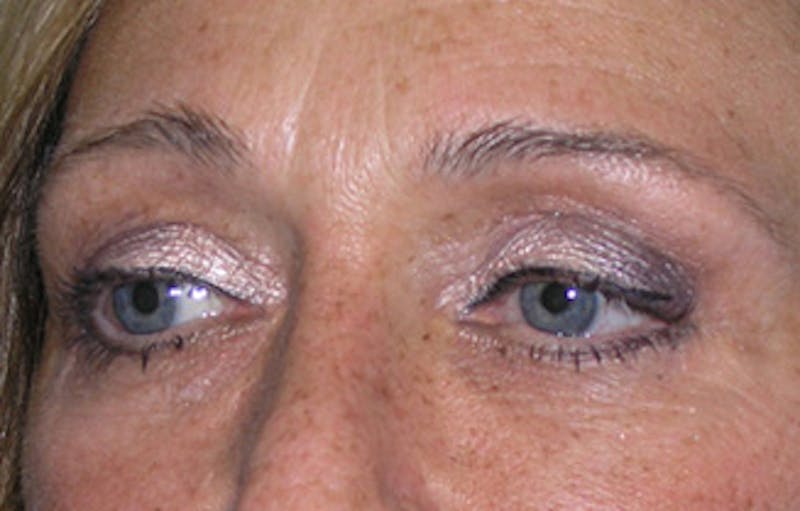 Eyelid Surgery Before & After Gallery - Patient 407452 - Image 6