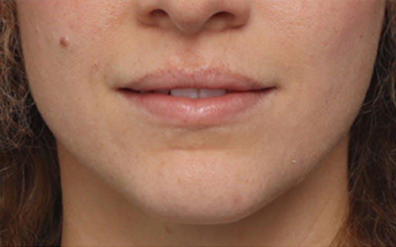 Lip Fillers Before & After Gallery - Patient 298153 - Image 1