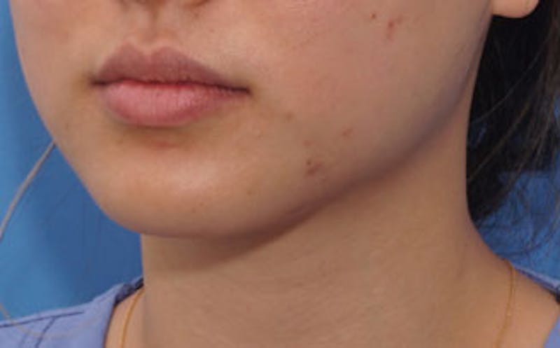 BOTOX Before & After Gallery - Patient 311603 - Image 6