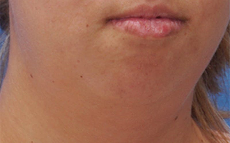 Chin Surgery Before & After Gallery - Patient 317660 - Image 3