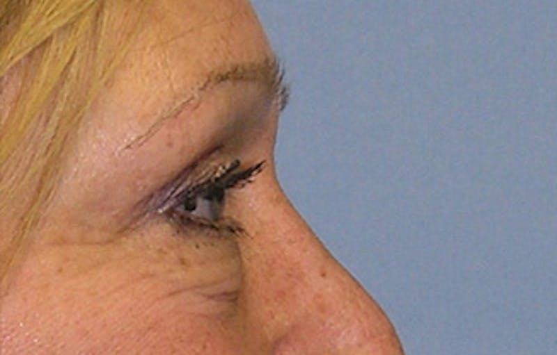 Eyelid Surgery Before & After Gallery - Patient 407452 - Image 7