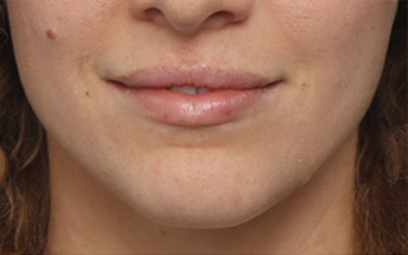 Lip Fillers Before & After Gallery - Patient 298153 - Image 2