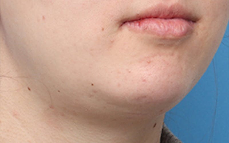 Chin Surgery Before & After Gallery - Patient 317660 - Image 4