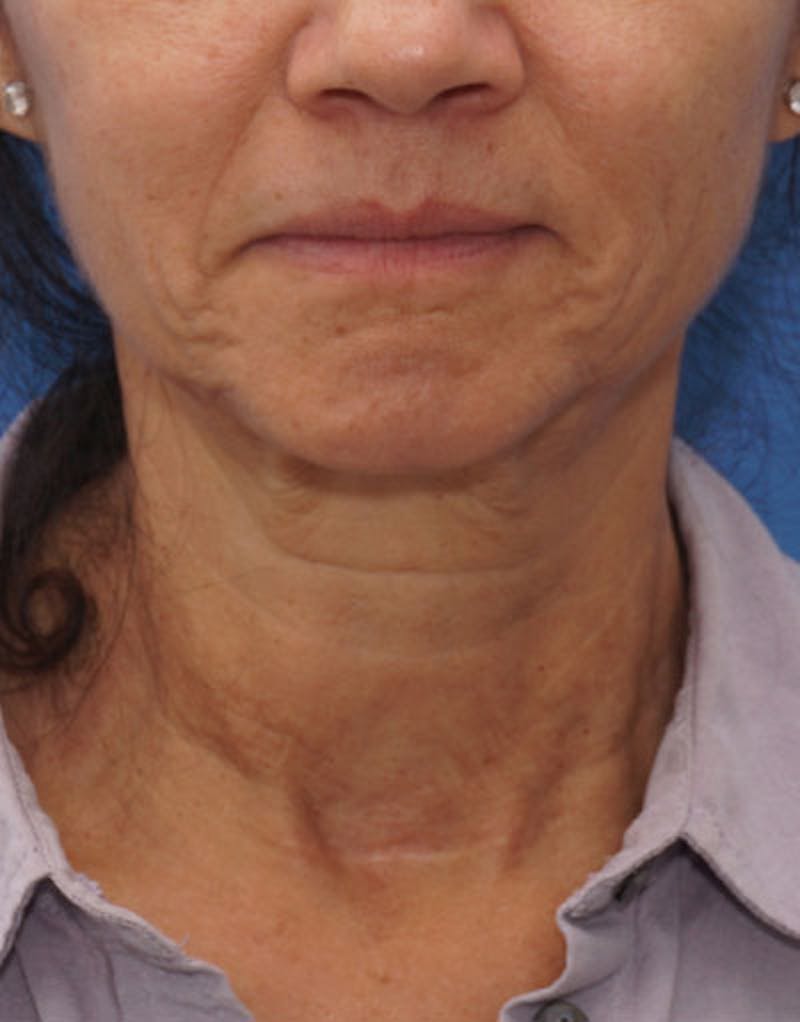 FaceTite Before & After Gallery - Patient 136492 - Image 5