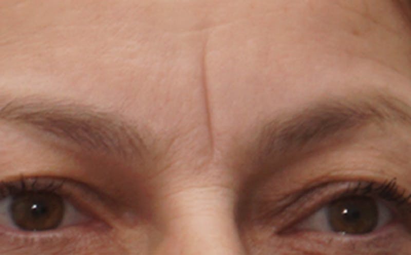 BOTOX Before & After Gallery - Patient 136826 - Image 1