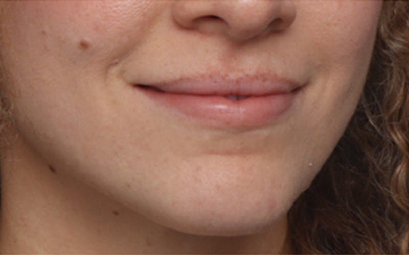 Lip Fillers Before & After Gallery - Patient 298153 - Image 3