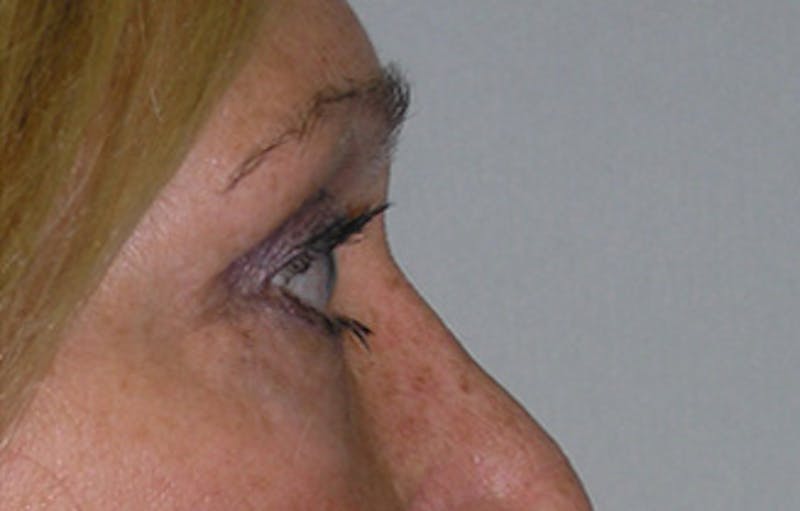 Eyelid Surgery Before & After Gallery - Patient 407452 - Image 8