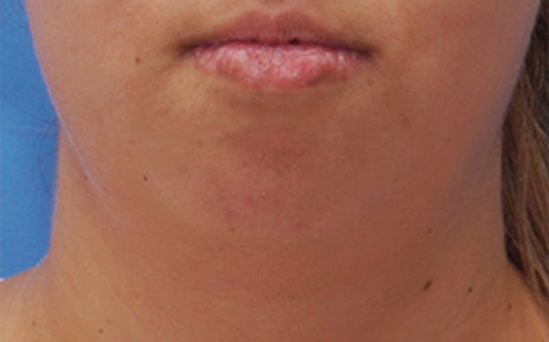 Chin Surgery Before & After Gallery - Patient 317660 - Image 5