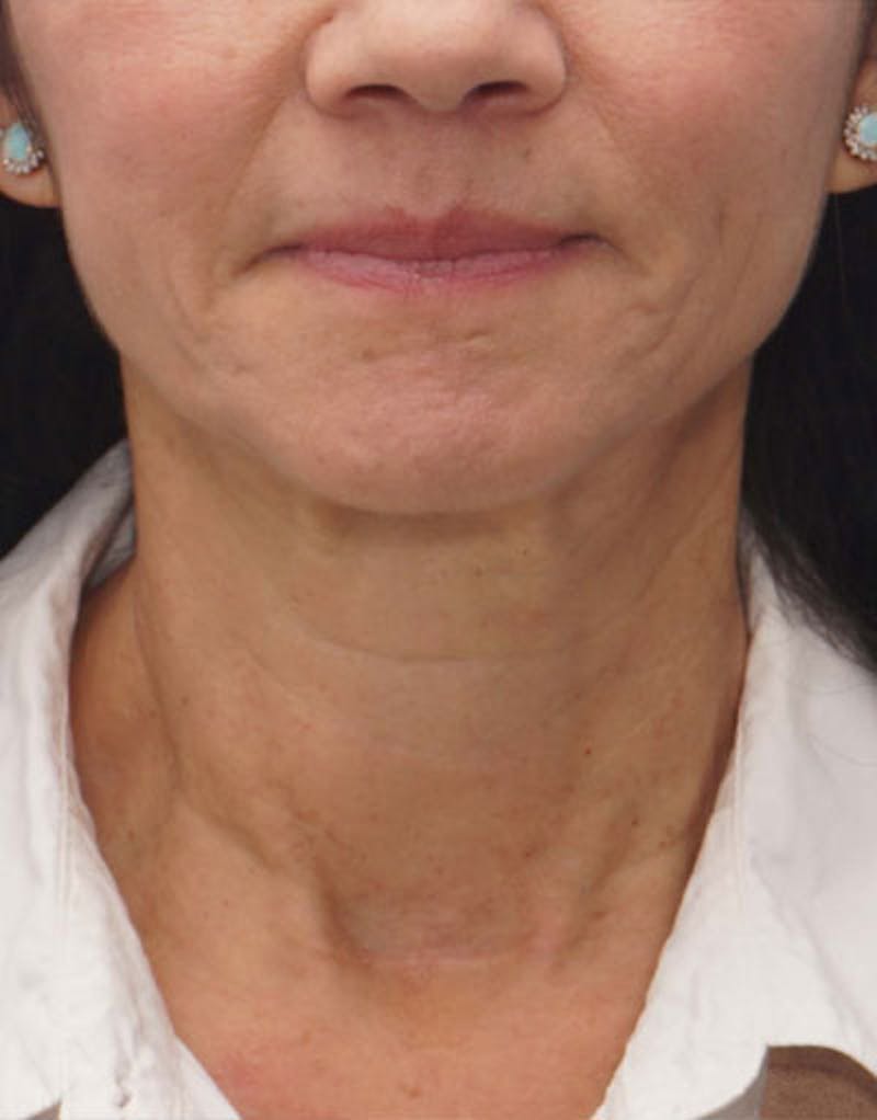 FaceTite Before & After Gallery - Patient 136492 - Image 6