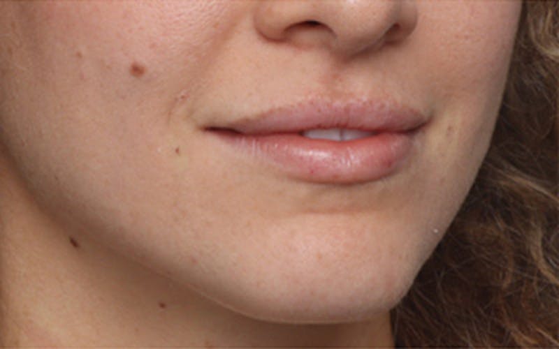 Lip Fillers Before & After Gallery - Patient 298153 - Image 4