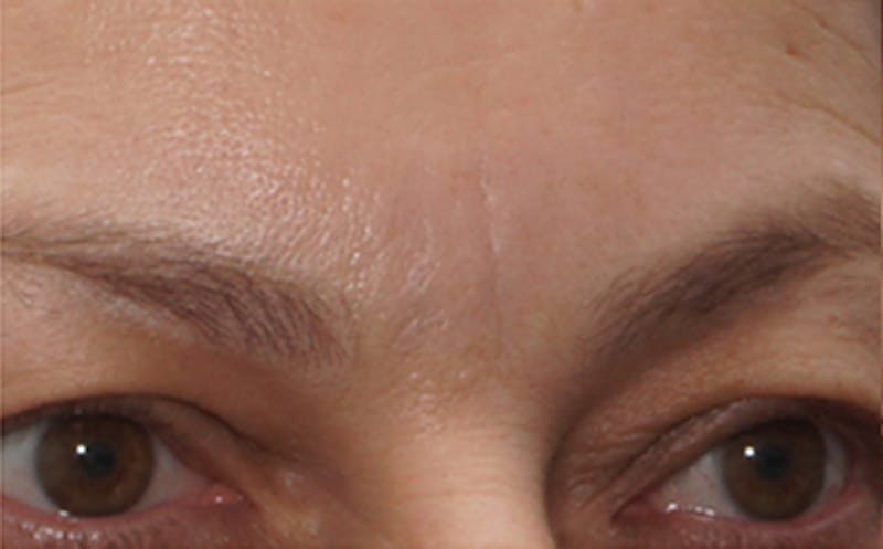 BOTOX Before & After Gallery - Patient 136826 - Image 2