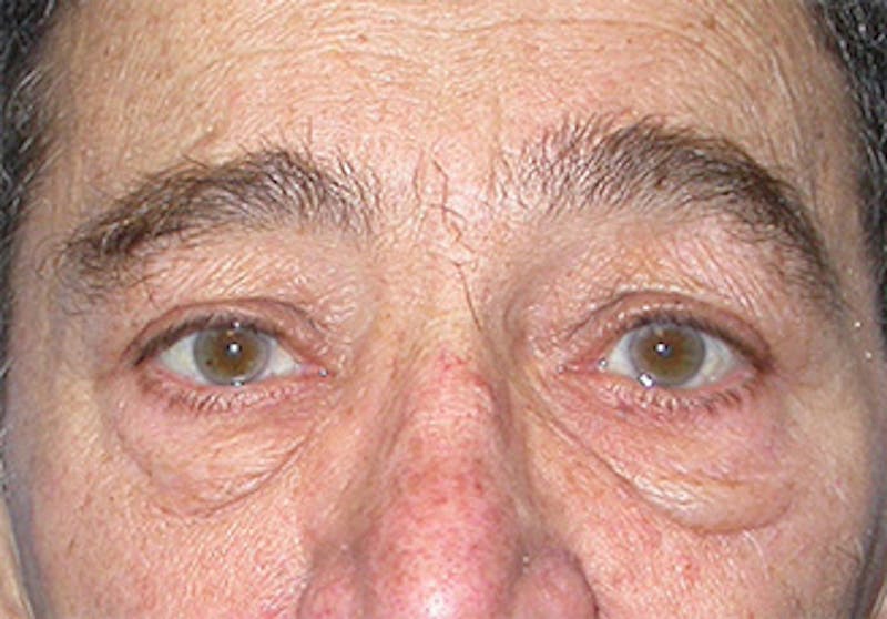 Eyelid Surgery Before & After Gallery - Patient 341727 - Image 1
