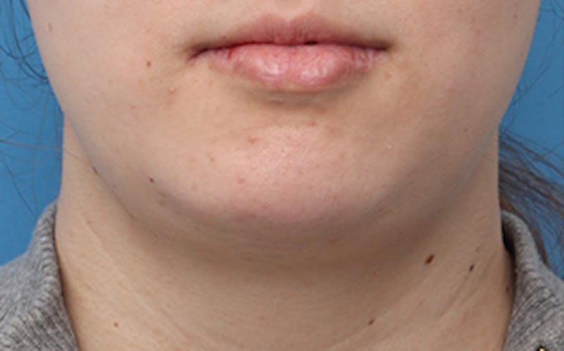 Chin Surgery Before & After Gallery - Patient 317660 - Image 6
