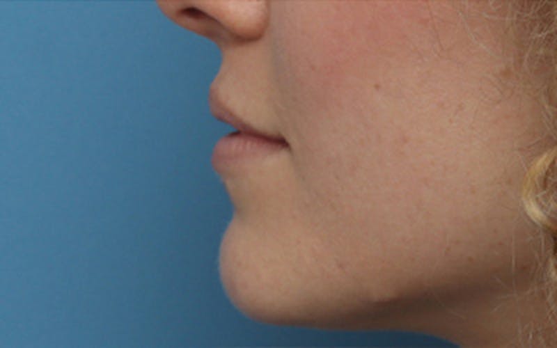 Lip Fillers Before & After Gallery - Patient 298153 - Image 5