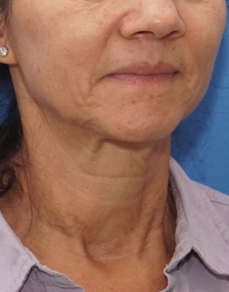 FaceTite Before & After Gallery - Patient 136492 - Image 7