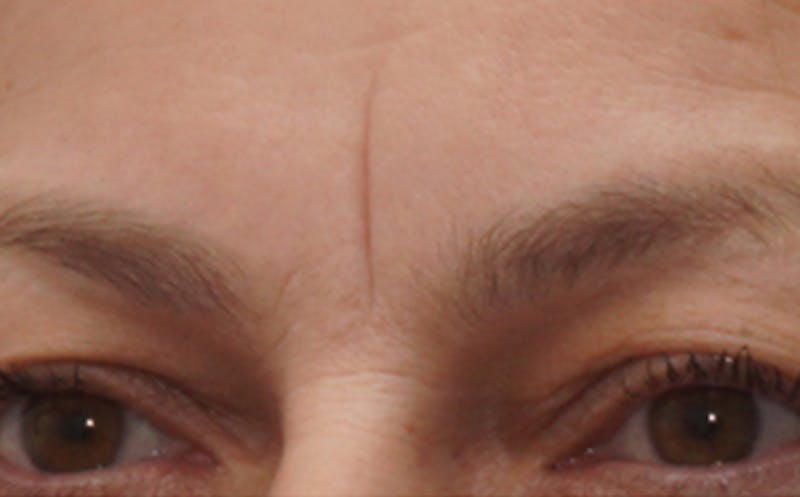 BOTOX Before & After Gallery - Patient 136826 - Image 3