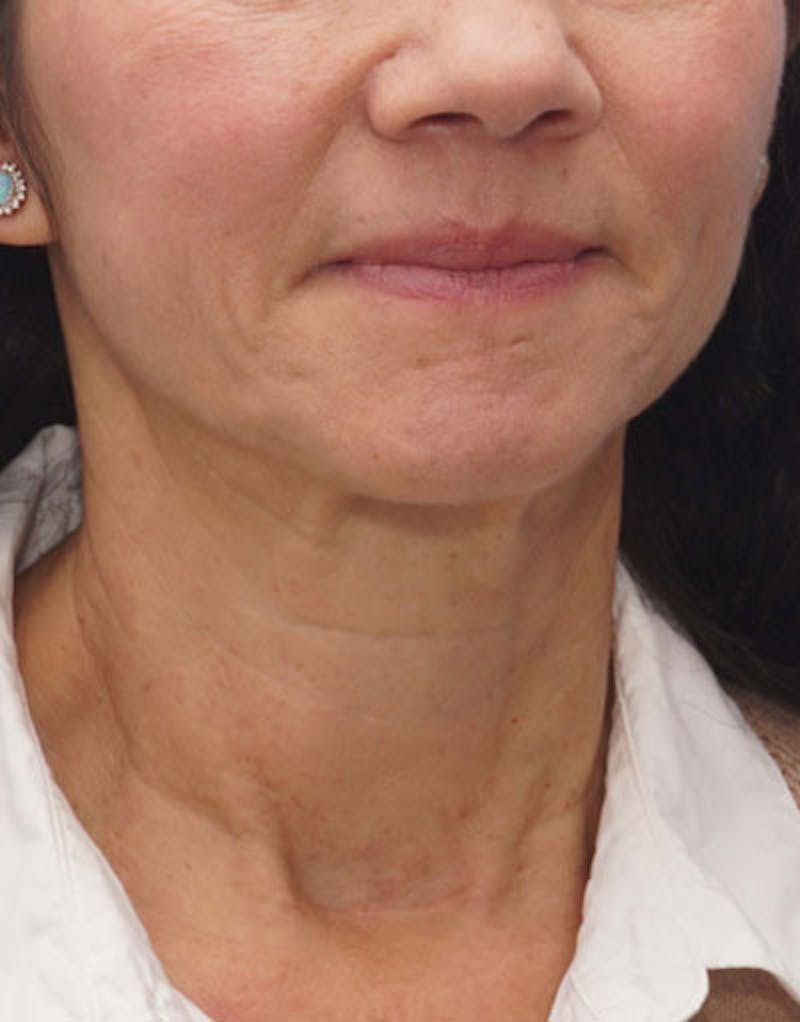 FaceTite Before & After Gallery - Patient 136492 - Image 8
