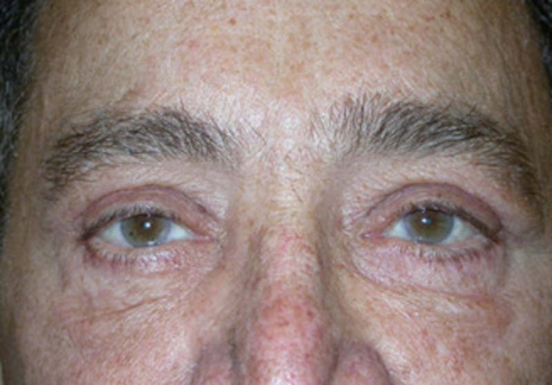 Eyelid Surgery Before & After Gallery - Patient 341727 - Image 2