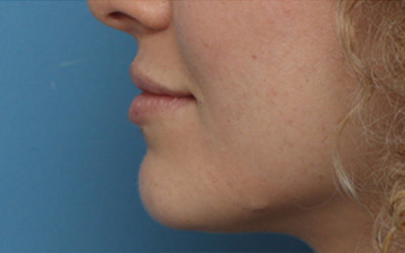 Lip Fillers Before & After Gallery - Patient 298153 - Image 6