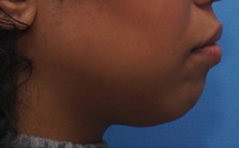 Chin Surgery Before & After Gallery - Patient 212061 - Image 1
